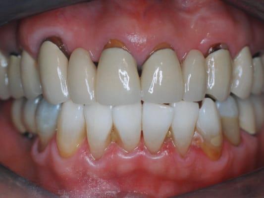 Old failing bridge on upper teeth.