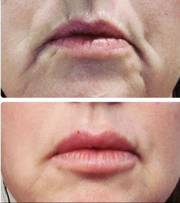 With 2 syringes of filler, say goodbye to the loss of lip volume and marionette lines!