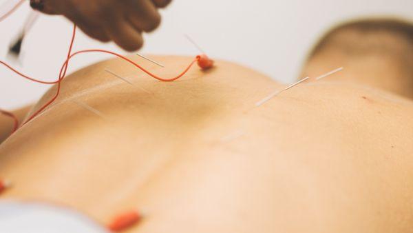 E=Stim therapy to increase stimulation to an acupuncture point.