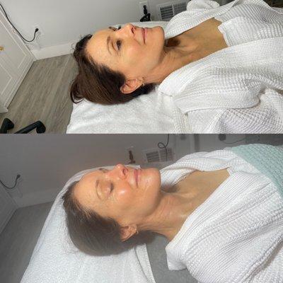 Signature aerolase facial.