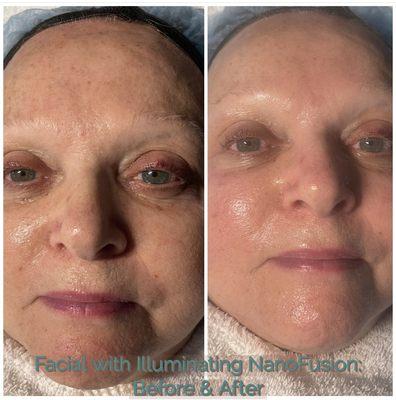 Facial with Nano Fusion