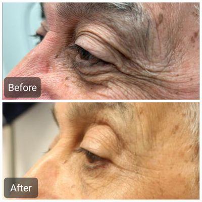 Laser eye lift as known as laser blepharoplasty Restores youthful contours around the eyes, Shorter downtime and recovery.