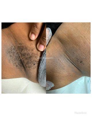 Arm Pit Waxing (Before /After)