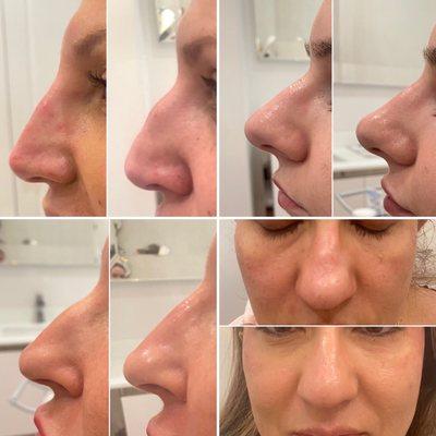 Non surgical nose jobs.. instant, no down time, minimal discomfort and a fraction of the price of surgery!