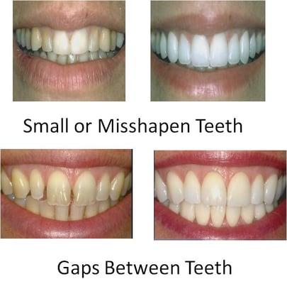 Misshapen Teeth or Gaps