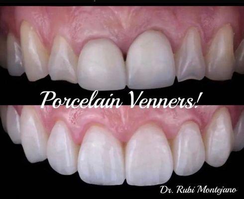 Smile makeover with laser gum lift and Veneers!