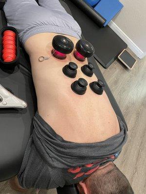 Utilizing cupping techniques to remove adhesions, improve circulation, and recovery