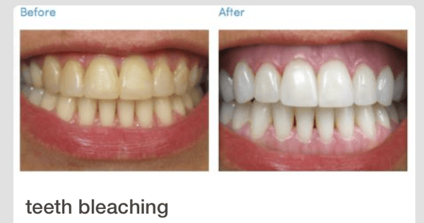 Teeth Whitening