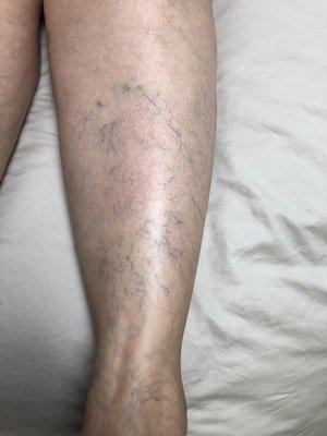 Spider vein removal (before)