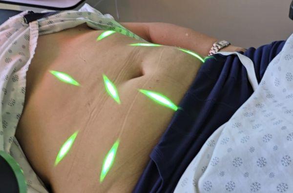 Green Laser Lipolysis machine