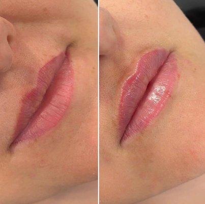 Lip fillers