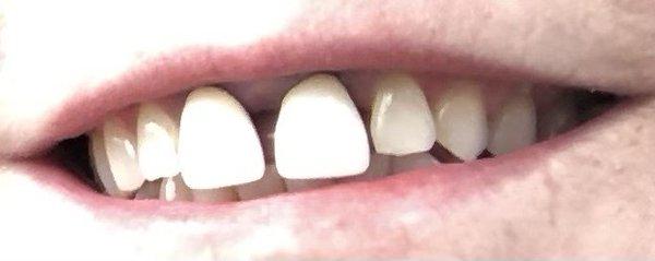 My crowns prior to Dr. Lo replacing them.