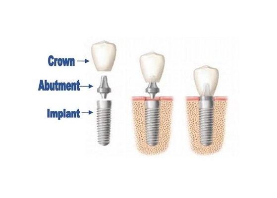 Implants are the best option for missing teeth.