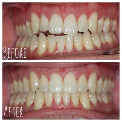 Correcting an anterior open bite with clear aligners