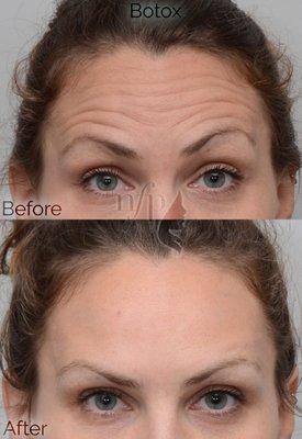 This is an example of a patient treated with Botox.  See how the forehead wrinkles relax after a single treatment.