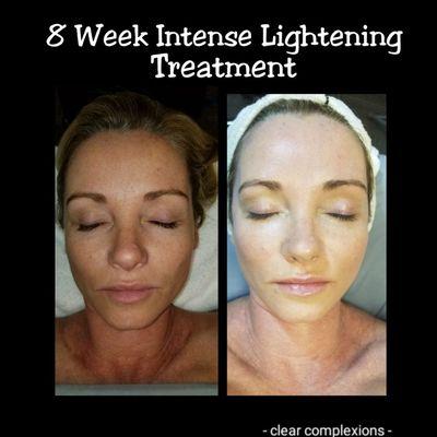 8-week Intense lightening treatment that delivers amazing results.