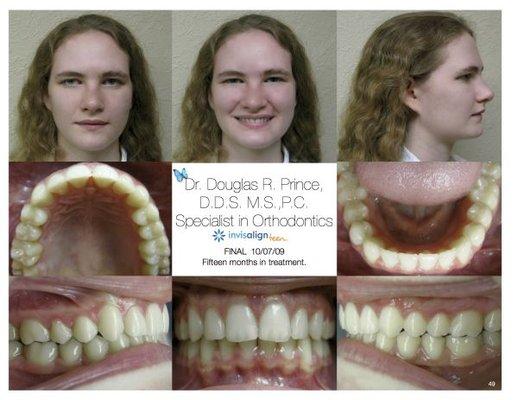 After Invisalign Teen