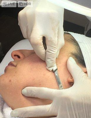 Dermaplaning.