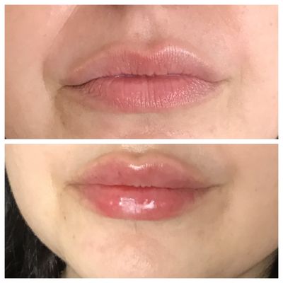 Lip filler