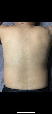 Before photo of men's full back sugaring hair removal