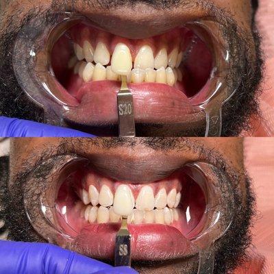 Advanced Teeth whitening