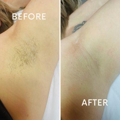 Before & after underarm sugar wax
3-4 of hair free softness!