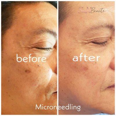 Microneedling: reduces wrinkles, improve fine lines,  encourage collagen production, reduce pore sizes, & improve acne scars