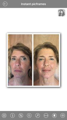 Micro-Current Facial treatment Before&After