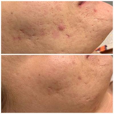 Microneedling results