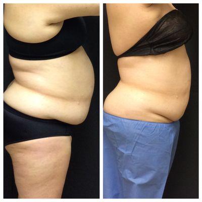 more on coolsculpting