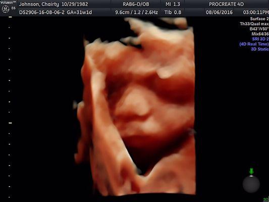 Procreate 4D High Definition Ultrasound (HDLIVE) 31 weeks. (SCROLL DOWN FOR NEWER IMAGES)