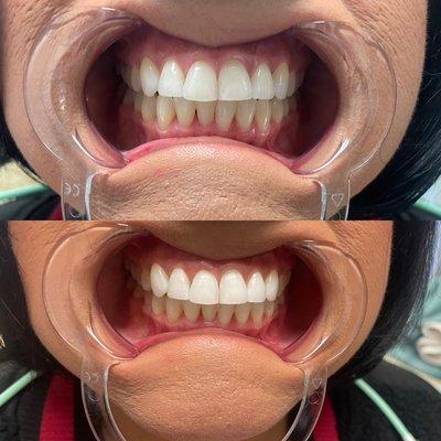 Teeth whitening before and after!