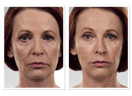 Juvederm collection of fillers.