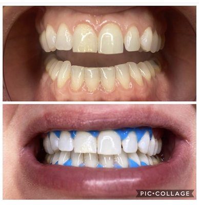 1 hour teeth whitening session