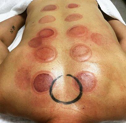 Cupping helps improve immune function by moving lymphatic fluid and blood throughout the body. Great for muscular tension.