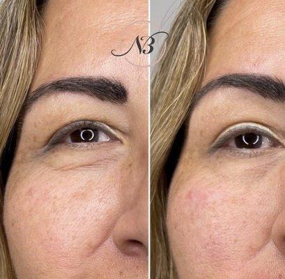 Juvaderm Ultra Plus injected under the eyes and mid face