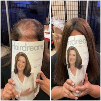 Before & After MicroLines Hair Topper for thinning hair solutions