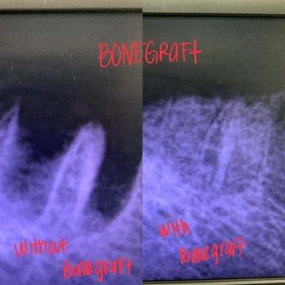 X-ray on Left extraction site w/o bone graft x-ray on the right shows extraction site with bone graft.  Bone graft promotes faster healing