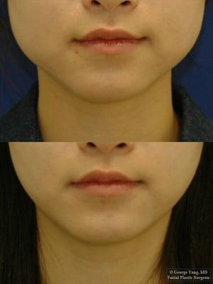 Botox Masseter Reduction for Masseter Hypertrophy and Bruxism (Teeth Grinding)
4 months after initial treatment