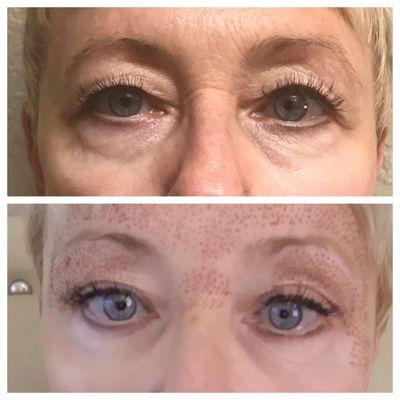 Upper eyelid lift, Eye lift, glabella, and crows feet- 2nd treatment