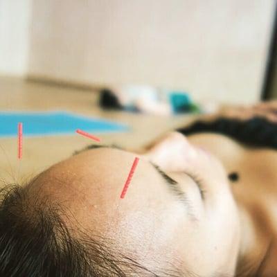 Community acupuncture events