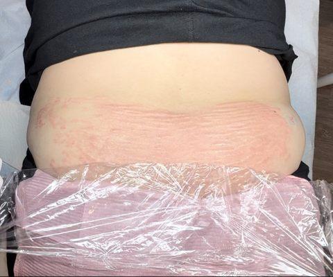 Stretch Marks Removal