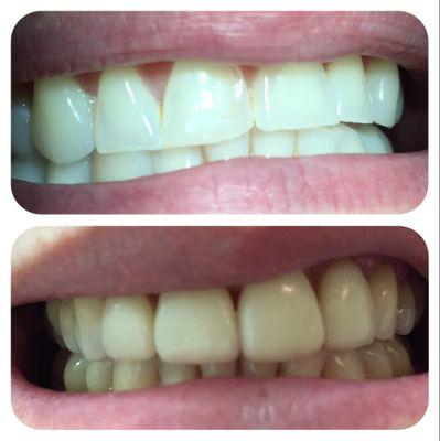 Smile makeover!  4unit veneer