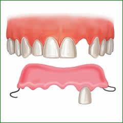 Temporary Partial Denture ( Flipper )