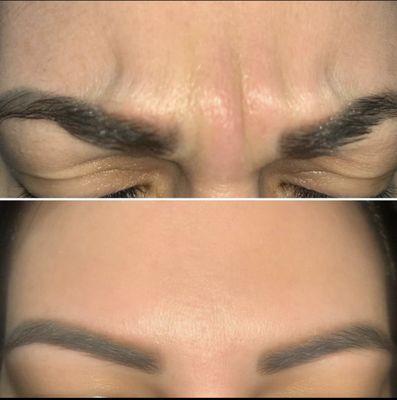 Say NO to frown lines! Botox before and after.