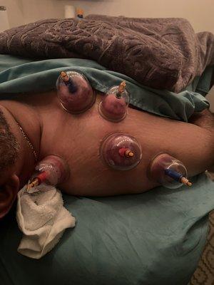 Cupping Therapy