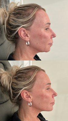 Chin and jawline filler