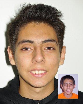 David before and after braces