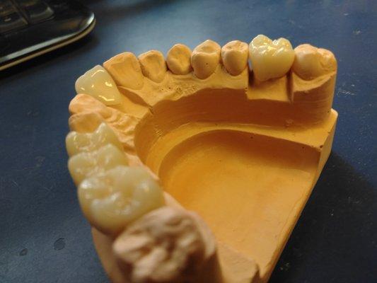 Full layered Zirconia Crown