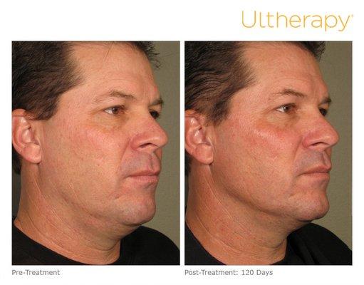 Full face Ulthera skin tightening